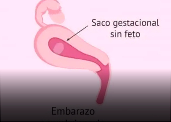 ¿Embarazo sin bebé? Esto es lo que ocurre en un “huevo huero”