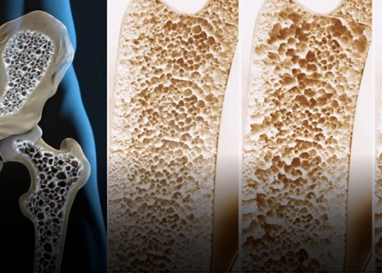 La osteoporosis, una enfermedad silenciosa que debilita los huesos